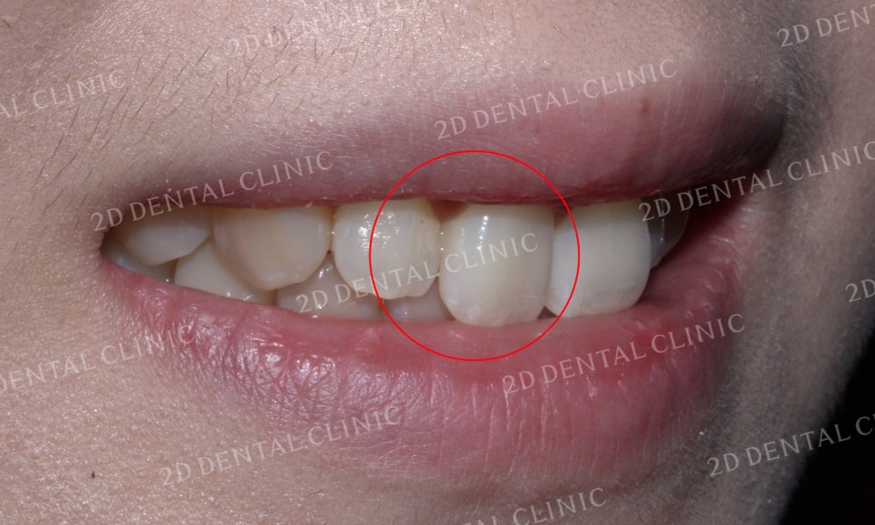 나비치아교정, 부분교정으로 나비치아 탈출하기! by.투디치과(2D치과) 관련 이미지 5