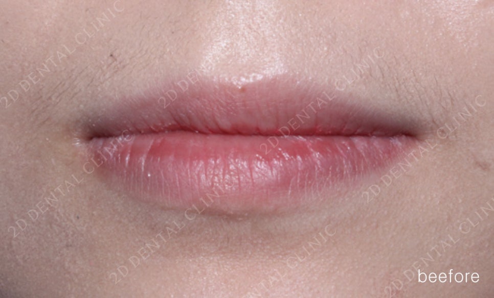 토끼이빨 치아교정 치료 사례 관련 이미지 7