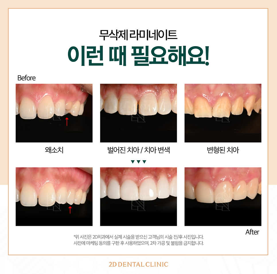 무삭제라미네이트부작용 2D치과블랙필름 A to Z 관련 이미지 3