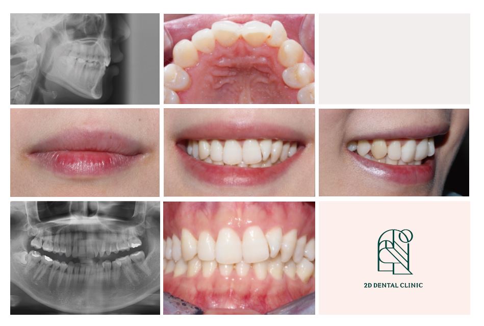 덧니치아 앞니교정 4개월 교정 완료! by. 투디치과(2D치과) 관련 이미지 2