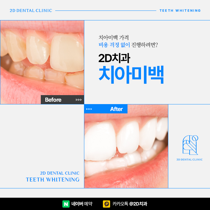 치아미백 가격, 비용 걱정 없이 진행하려면, 신논현 치아미백 치과 관련 이미지 1