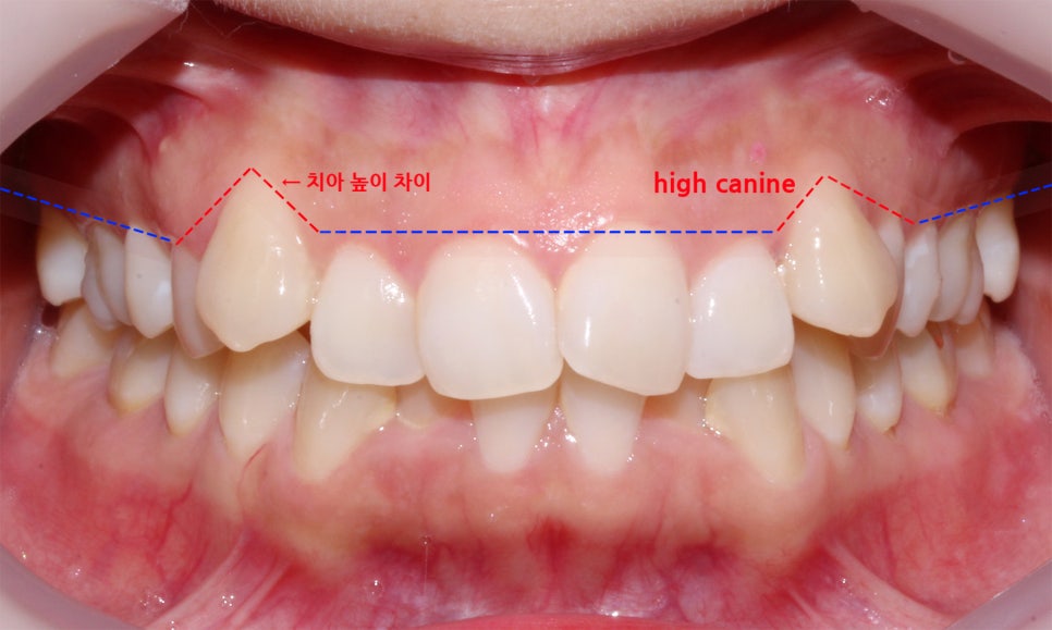 역삼역치과 송곳니덧니 crowding Case 관련 이미지 1