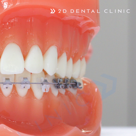 콤비교정, 합리적인 비용으로 돌출입 개선하자! 강남 투디치과 관련 이미지 2