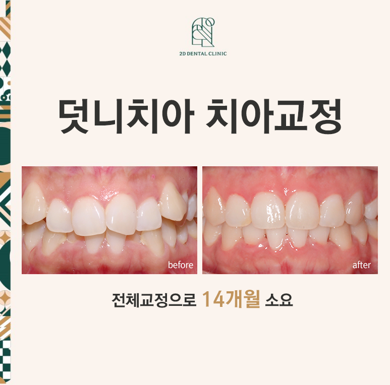 돌출입 탈출기! 덧니 교정도 문제없어! by.투디치과(2D치과) 관련 이미지 1