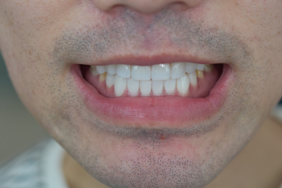 라미네이트치과 알아본다면? 관련 이미지 9