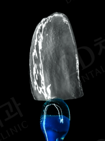 강남라미네이트 무삭제 치아성형 블랙필름 관련 이미지 7