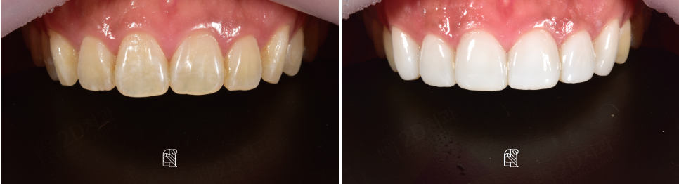 강남라미네이트치과 추천 : 진짜 무삭제, 투디치과! 관련 이미지 10