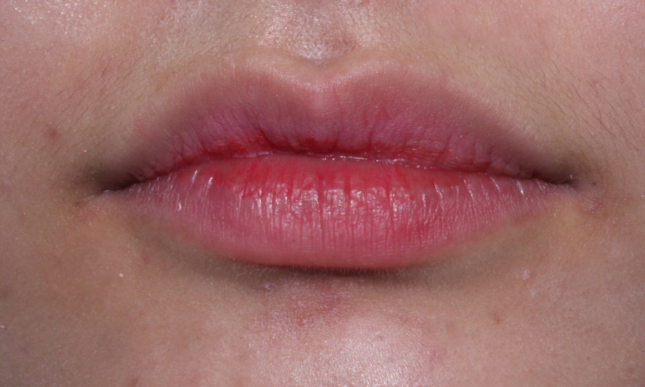 반포치과 뻐드렁니교정 방법은? 관련 이미지 7