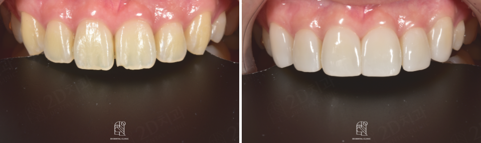 무삭제블랙필름 실제 후기 관련 이미지 6