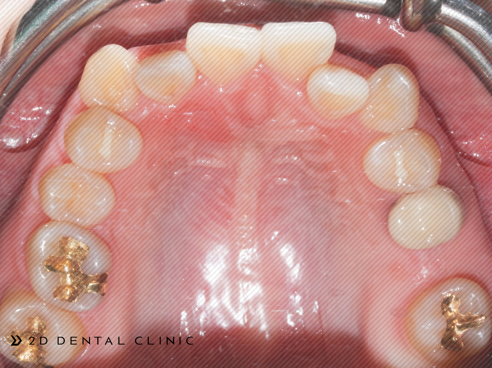 발치교정 돌출입 케이스, 교정전문 2D치과 관련 이미지 5