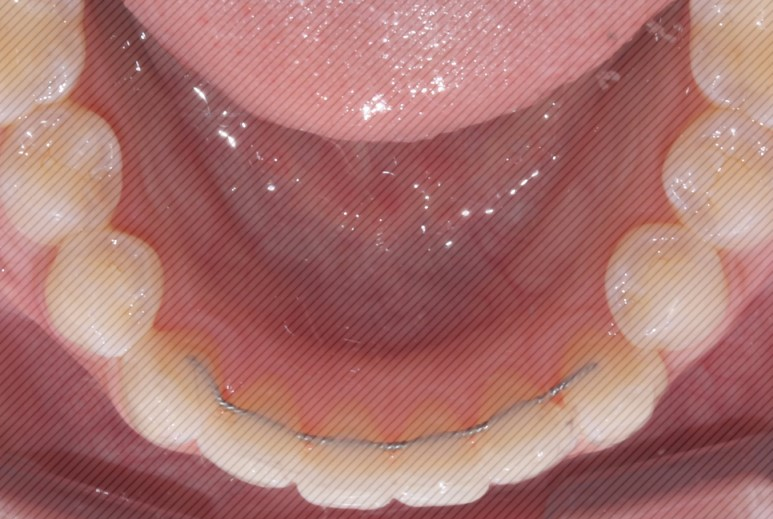 [신논현역치과] 앞니돌출 2D교정으로 개선! 관련 이미지 10