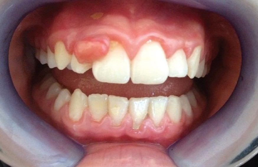 일요일에 문여는 치과  아파죽을것같은데 살려주세요 :: 신논현역 2D치과 관련 이미지 5