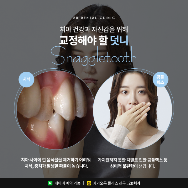 덧니가 두드러져 스트레스일 땐? 2D부분교정 관련 이미지 3