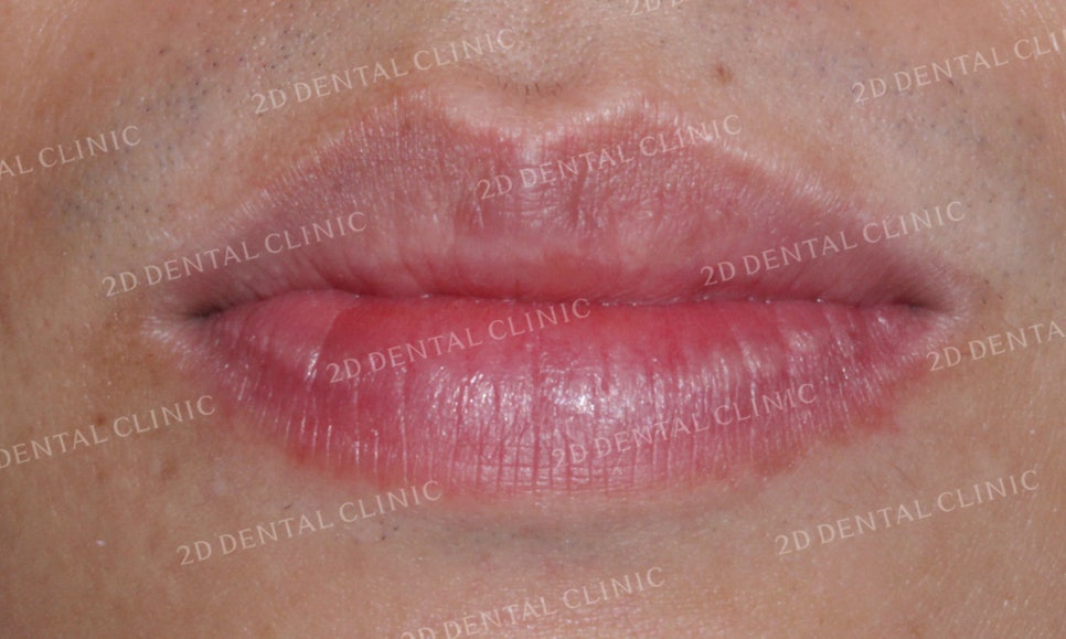 [앞니교정]부정교합교정, 부분교정으로 완성하기! by.투디치과(2D치과) 관련 이미지 2