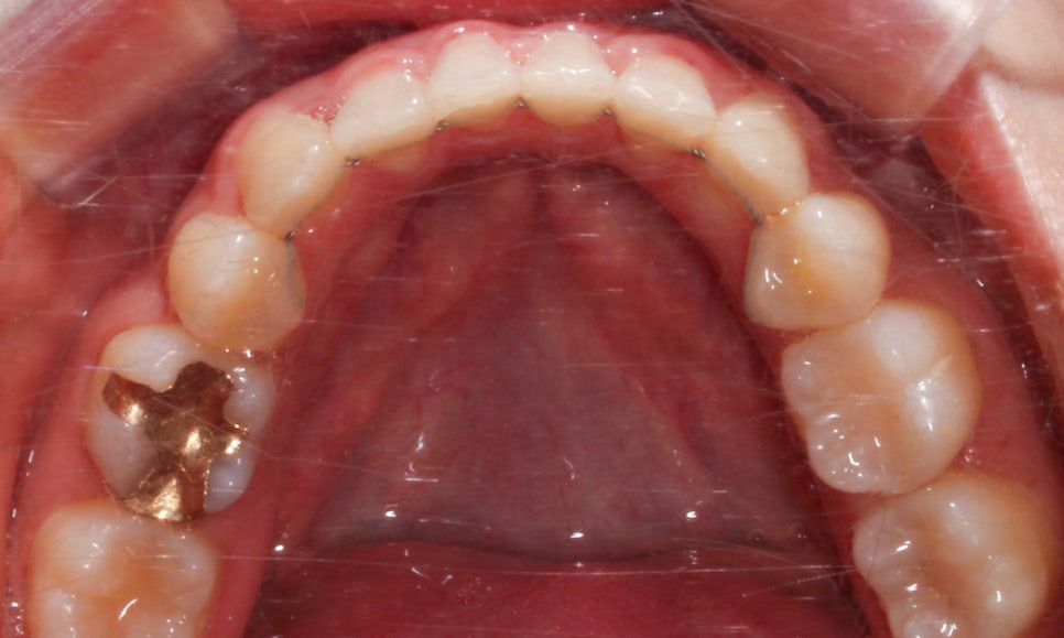 역삼역치과 송곳니덧니 crowding Case 관련 이미지 14