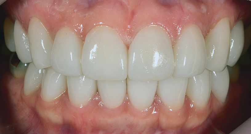 치아 블랙트라이앵글 원인, 예방, 치료 무삭제라미네이트 관련 이미지 8