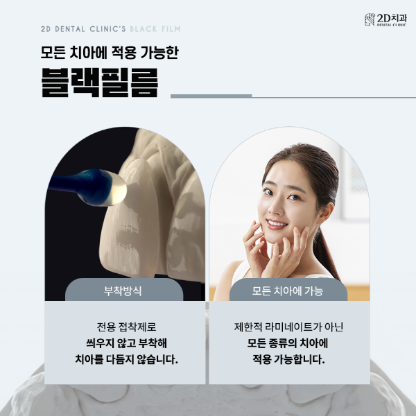"이건 몰랐지?" 프리미엄 앞니 라미네이트 <블랙필름> 관련 이미지 5