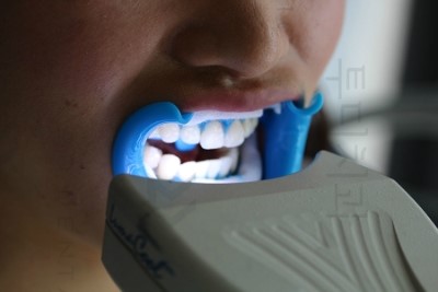 투디치과의 치아미백!! 관련 이미지 4