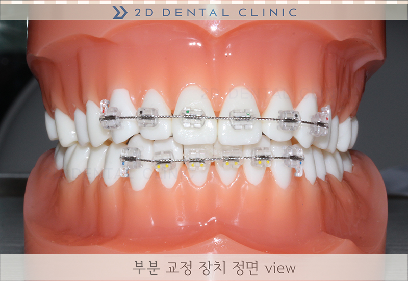앞니 부분교정 전체교정 비교, 강남 2D치과 관련 이미지 3