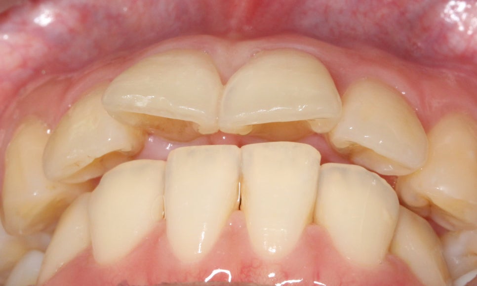 대치동치과 입툭튀 집어넣는 교정 관련 이미지 2