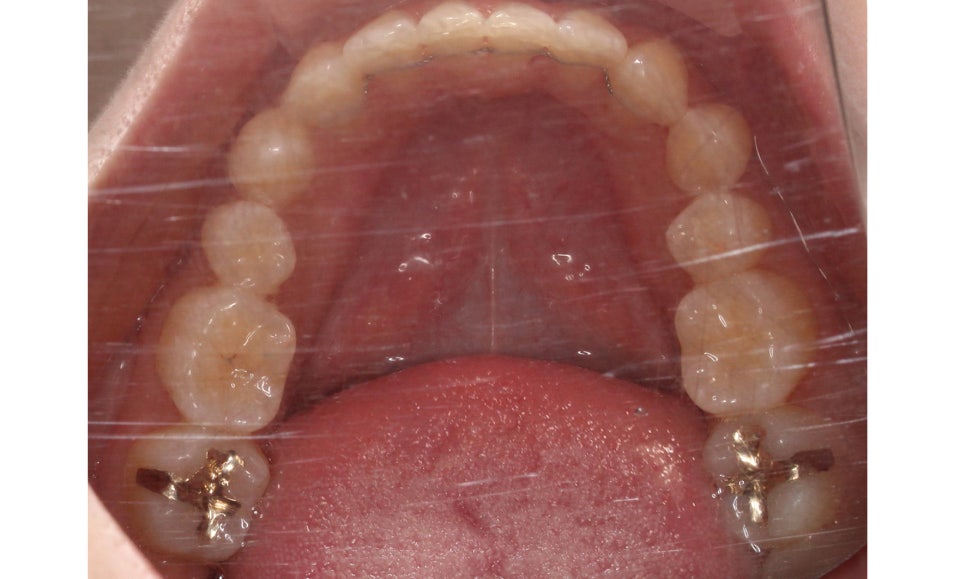 신논현치과 자가결찰브라켓 장점 관련 이미지 16