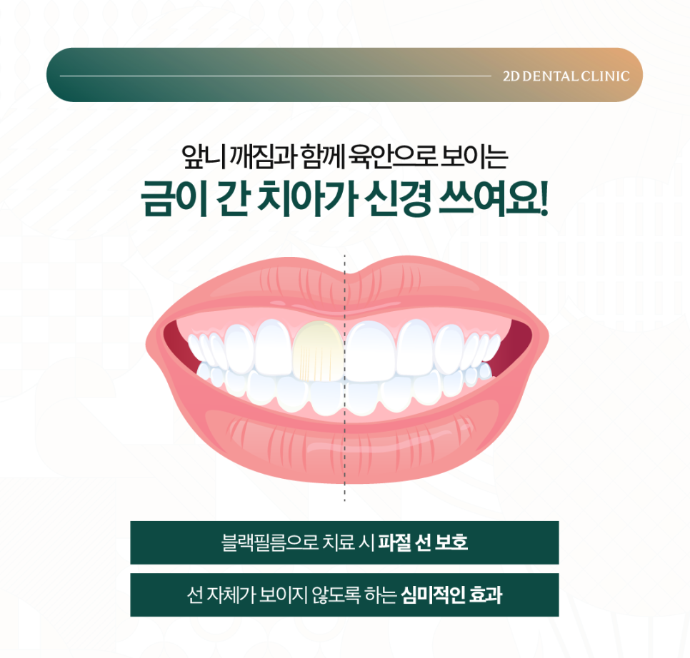 무삭제라미네이트비용 치아깨짐 파절된 앞니 보완하고 싶다면 관련 이미지 5