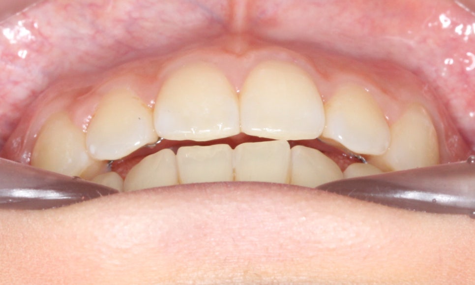 나비앞니 세라믹교정 case 관련 이미지 9