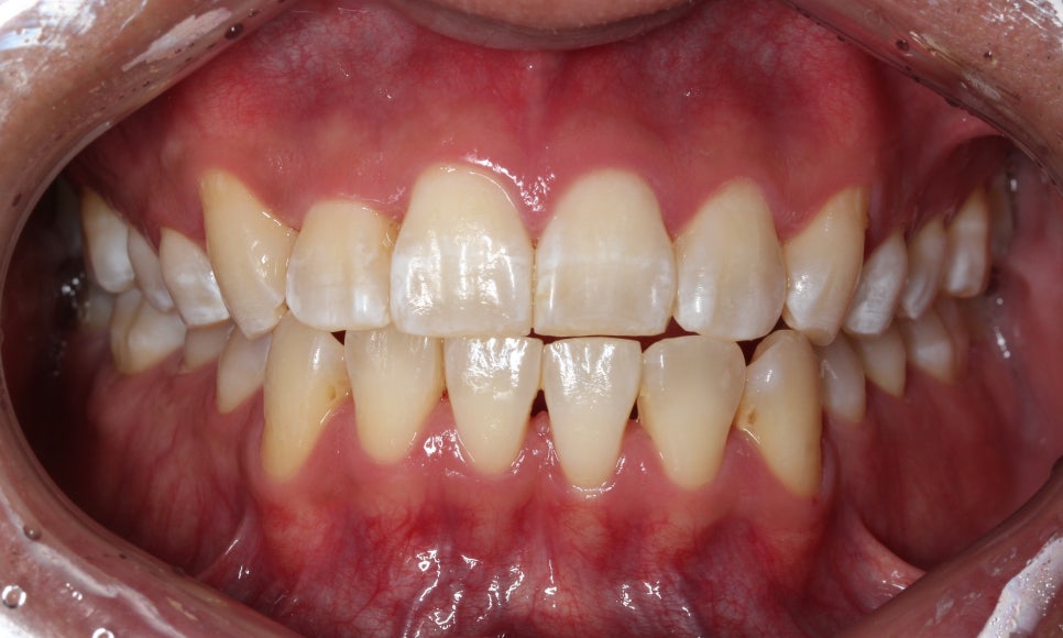 앞니 덧니 고민, 부분 설측 교정으로 해결한 사례 관련 이미지 10