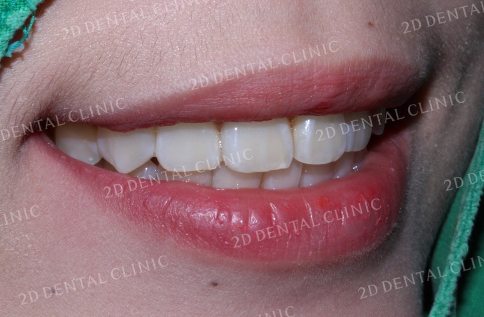 돌출입, 돌출앞니를 부분교정으로 고르게! by.투디치과(2D치과) 관련 이미지 16