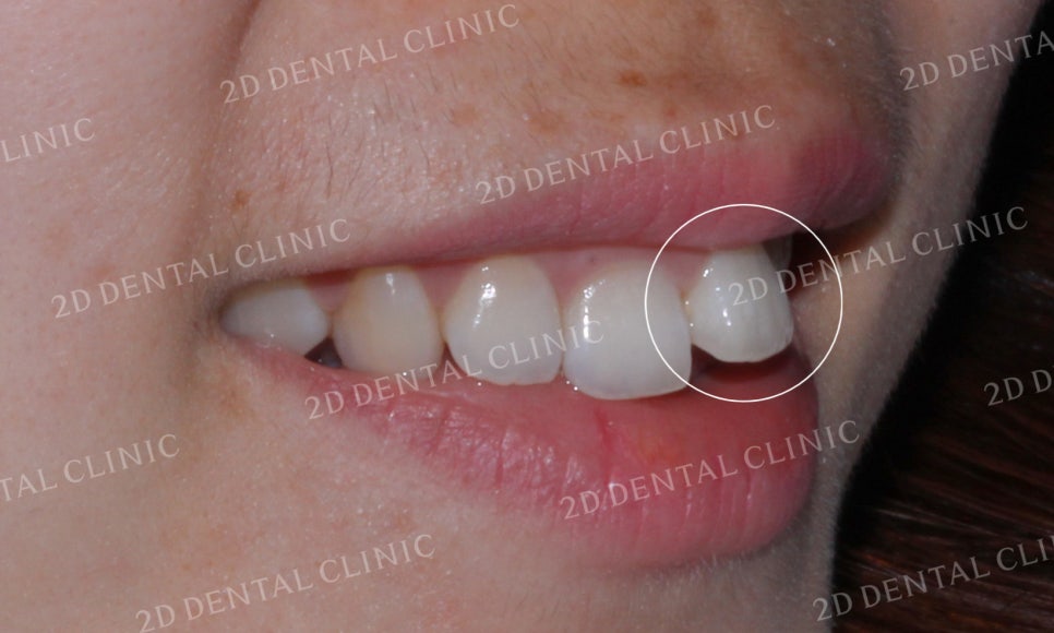 [투디교정] 덧니교정, 앞니교정으로 치열을 고르게! by.투디치과(2D치과) 관련 이미지 4