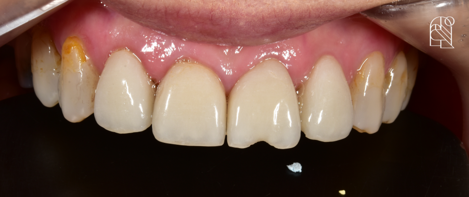 앞니깨짐 (앞니파절) 치료방법 세 가지 - 레진, 라미네이트, 크라운 관련 이미지 2