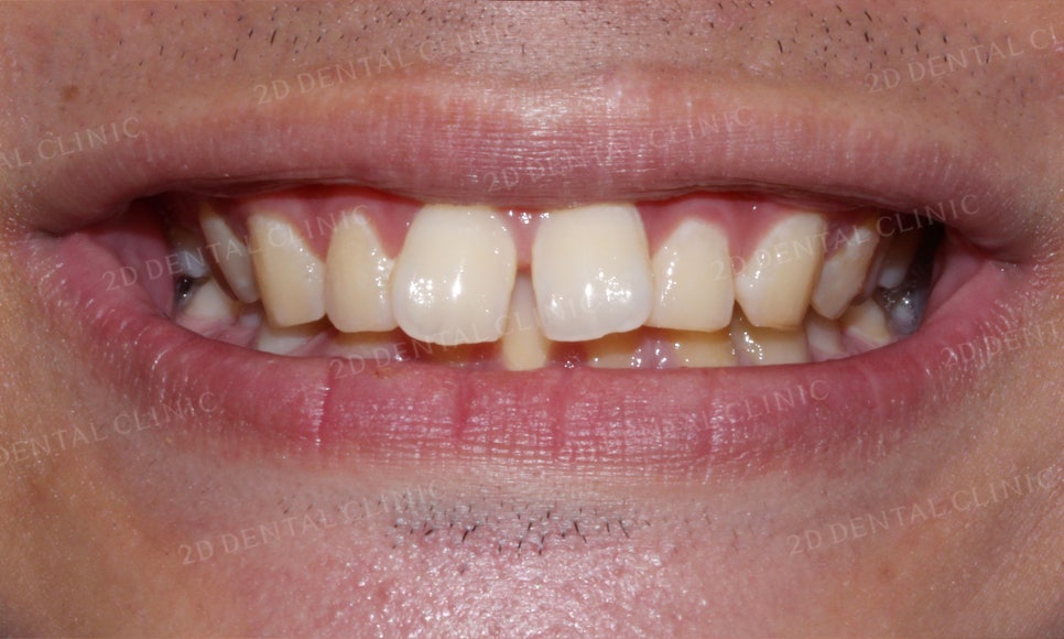 [앞니교정] 벌어진 앞니, 부분교정으로 앞니교정하기! by.2D치과(투디치과) 관련 이미지 3