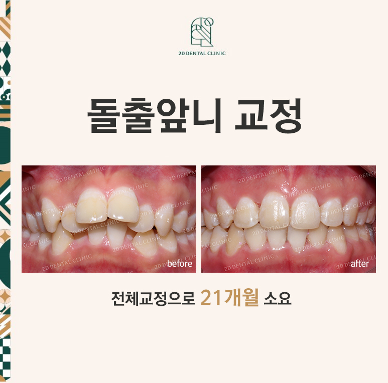 돌출앞니 교정, 튀어나온 입을 넣어보자! by.투디치과(2D치과) 관련 이미지 1