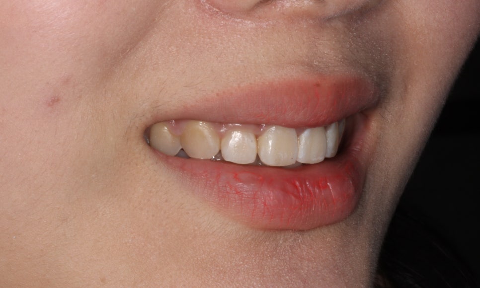 나비치아교정, 부분 치아교정으로 하고 싶다면? by.투디치과(2D치과) 관련 이미지 10