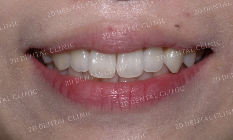 [앞니교정]토끼앞니교정, 부분교정으로 토끼이빨 탈출하기! by.투디치과(2D치과) 관련 이미지 2