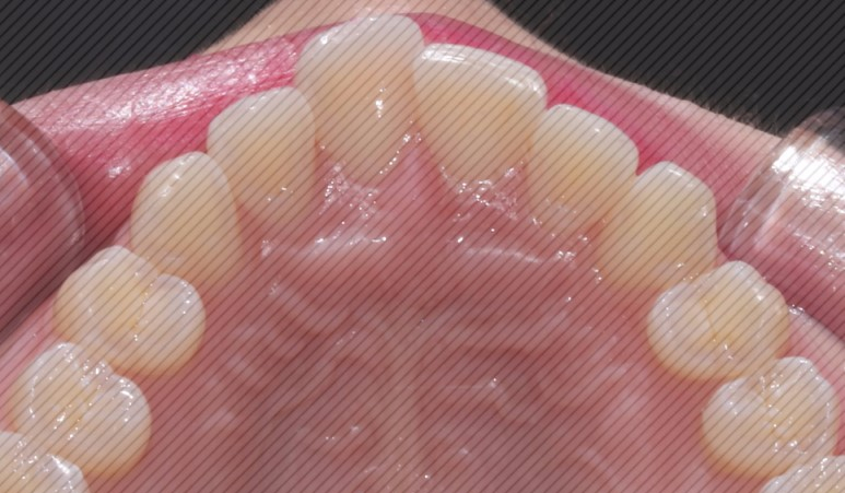 [신논현역치과] 앞니돌출 2D교정으로 개선! 관련 이미지 7