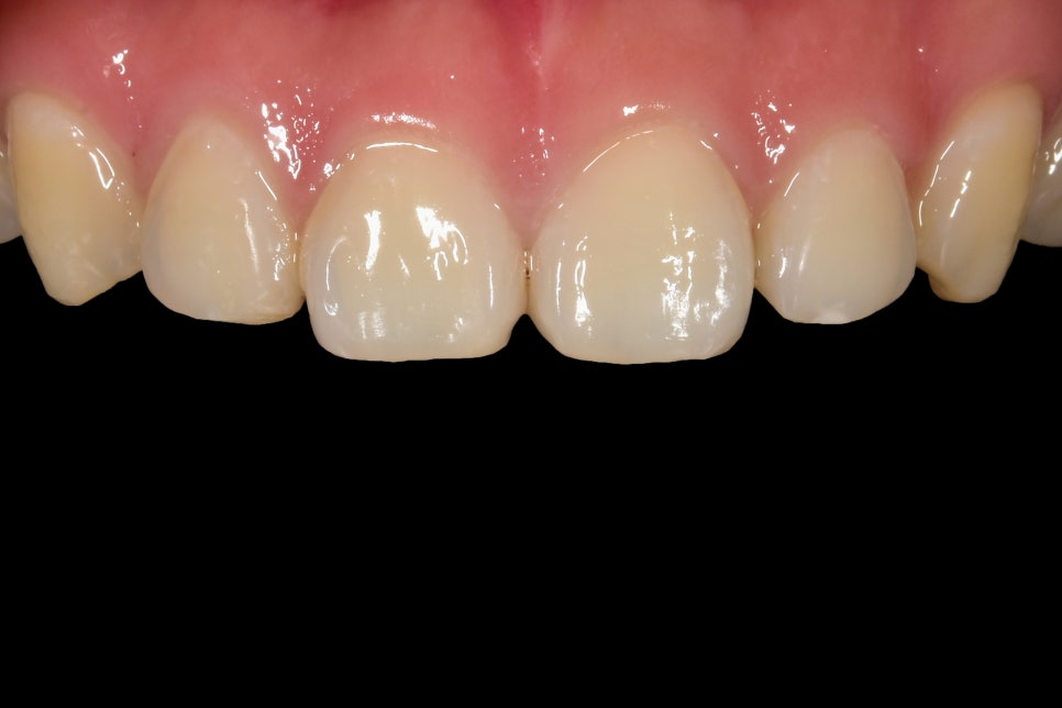 연예인라미네이트 무삭제로 잘하는 2D치과 관련 이미지 7