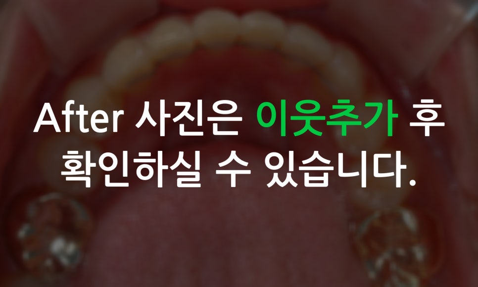 토끼앞니교정, PFM크라운 재보철을 동시에 치료하는 방법? 관련 이미지 9