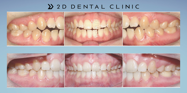 절단교합 교정 케이스 전후비교, 교정전문 2D치과 관련 이미지 18