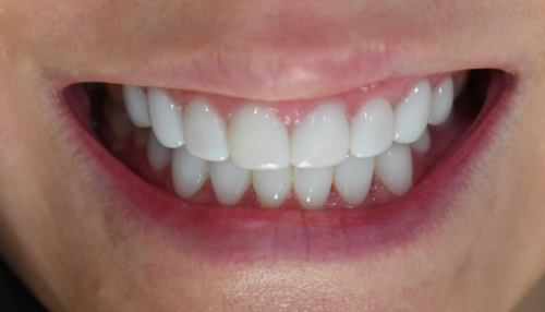 무삭제 라미네이트 블랙필름 솔직한 후기 : 라미네이트 가격, 비용 비교분석 관련 이미지 14