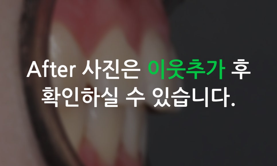 송곳니덧니 교정하는 방법! 관련 이미지 9