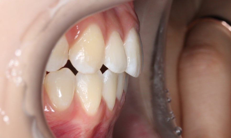 신논현치과 자가결찰브라켓 장점 관련 이미지 12