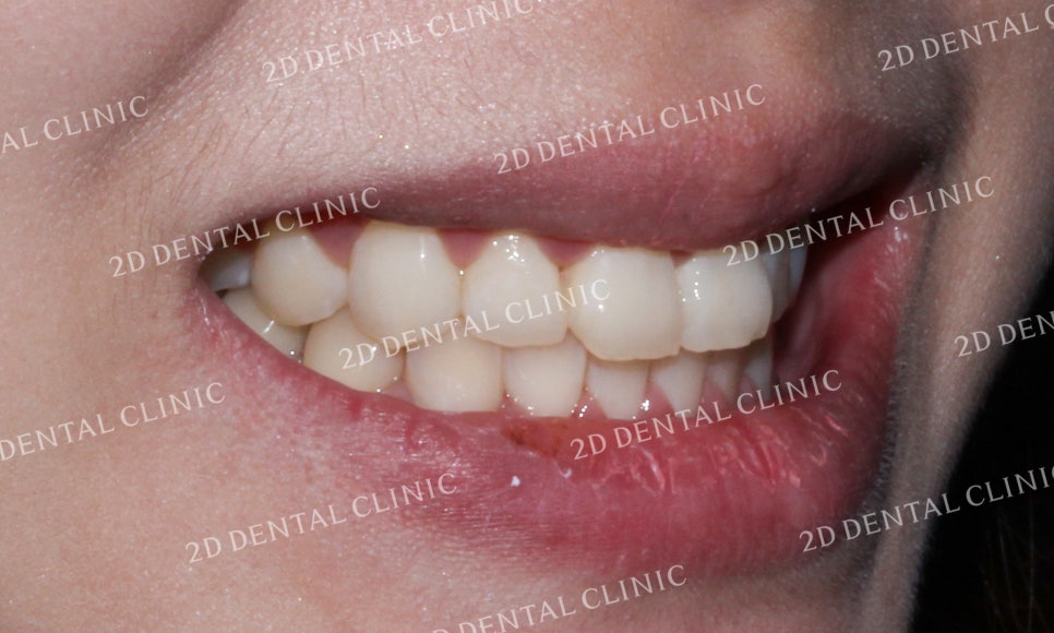 [투디교정] 덧니치아교정, 부분교정으로 쉽고 빠르게! by.투디치과(2D치과) 관련 이미지 12