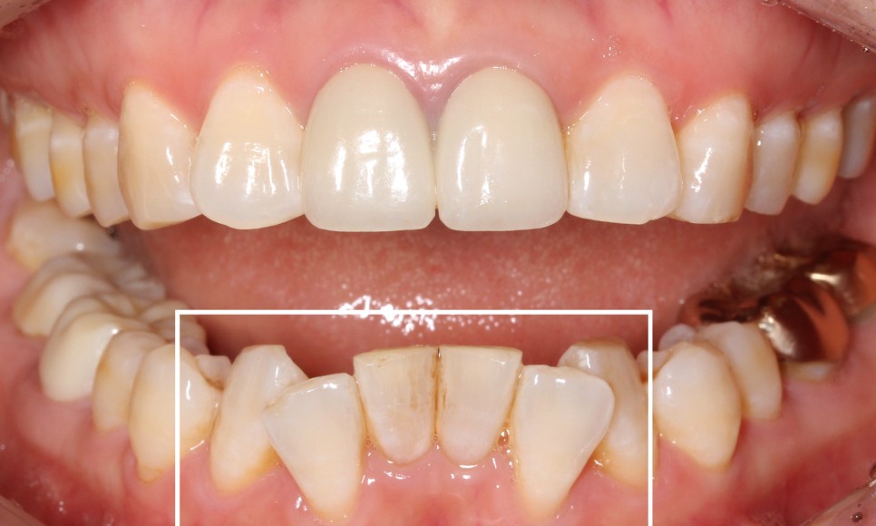 2D치과 2D부분교정으로 아랫니만 빠르게! 관련 이미지 4