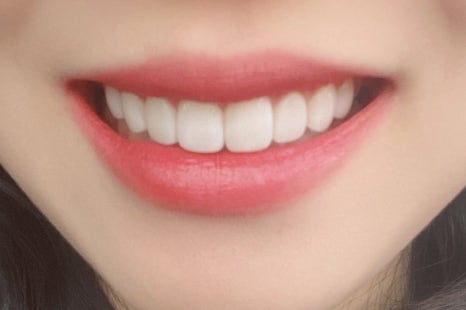 무삭제라미네이트후기 많은 고객님들의 찐후기가 많은 2D치과 관련 이미지 4