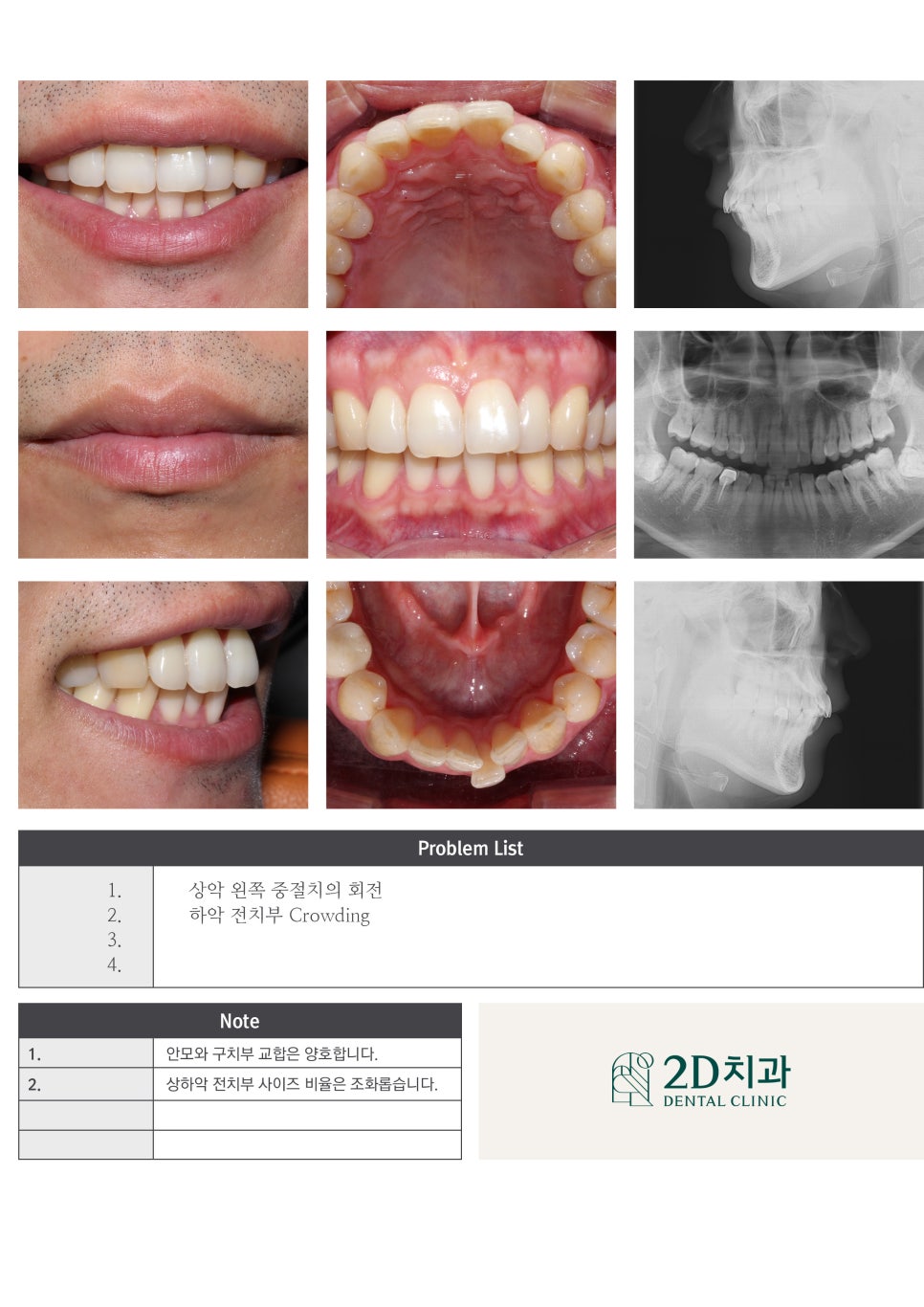 틀어진 앞니를 전체 교정으로 바르게! by.투디치과(2D치과) 관련 이미지 8
