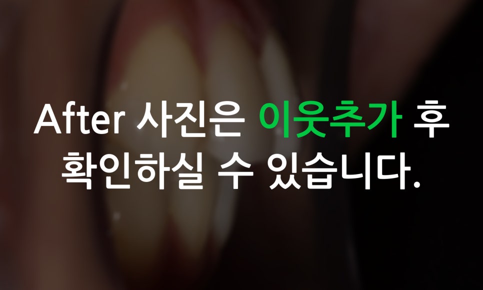 토끼앞니교정, PFM크라운 재보철을 동시에 치료하는 방법? 관련 이미지 13