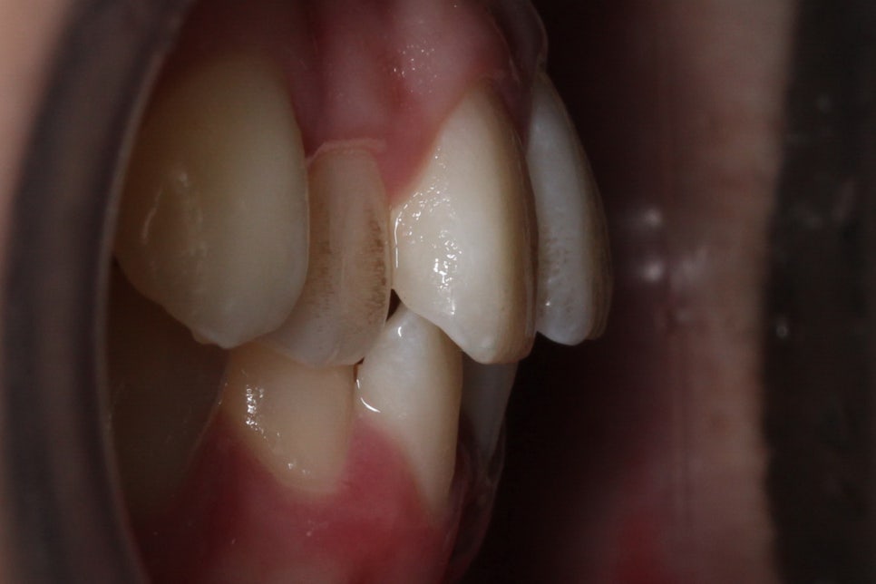 투디치과 송곳니덧니 치료 후기 관련 이미지 3