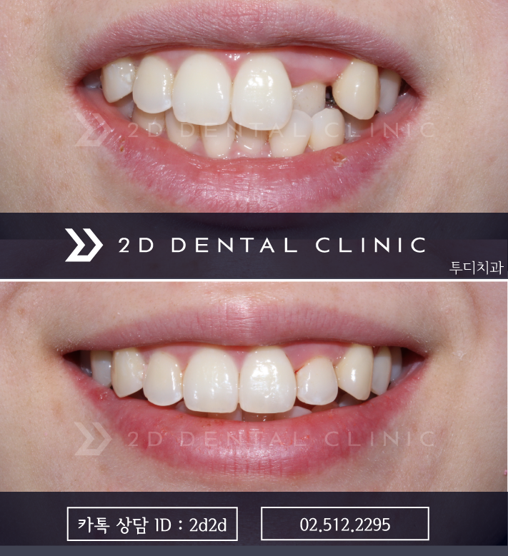 앞니 부분교정, 나의 경우에도 가능할까? 전후 사진 비교 관련 이미지 5