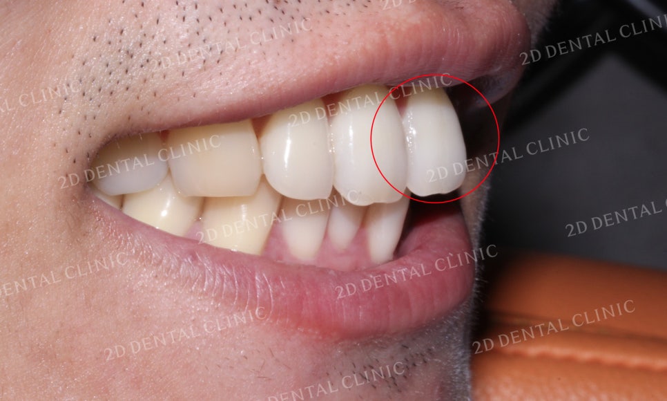 틀어진 앞니를 전체 교정으로 바르게! by.투디치과(2D치과) 관련 이미지 15